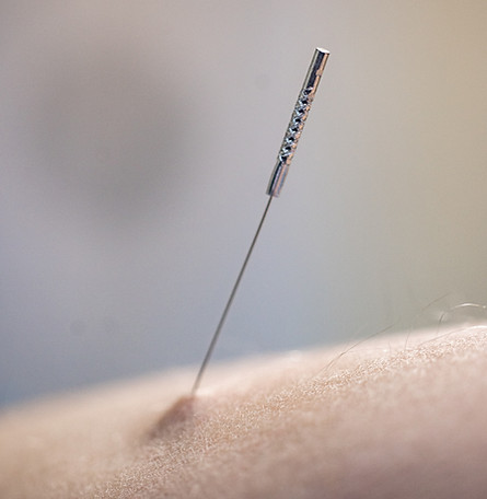 Dry Needling