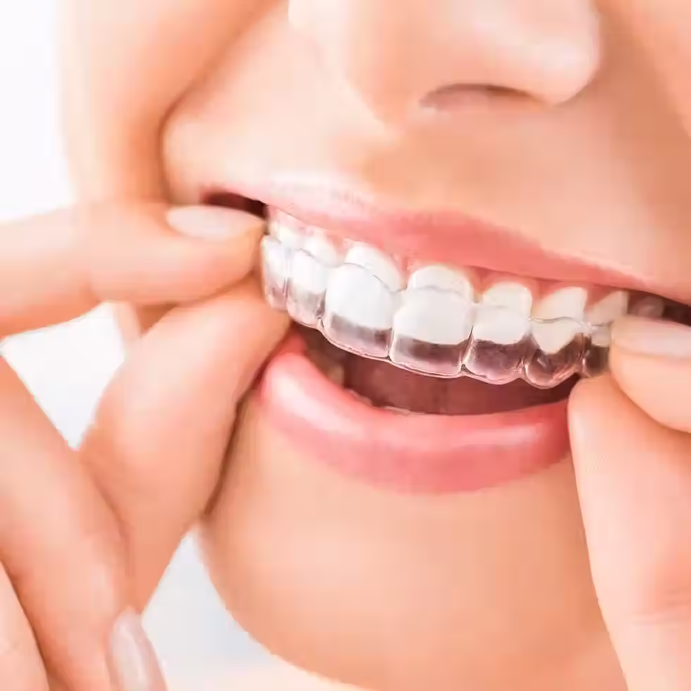 Clear aligners being put on.