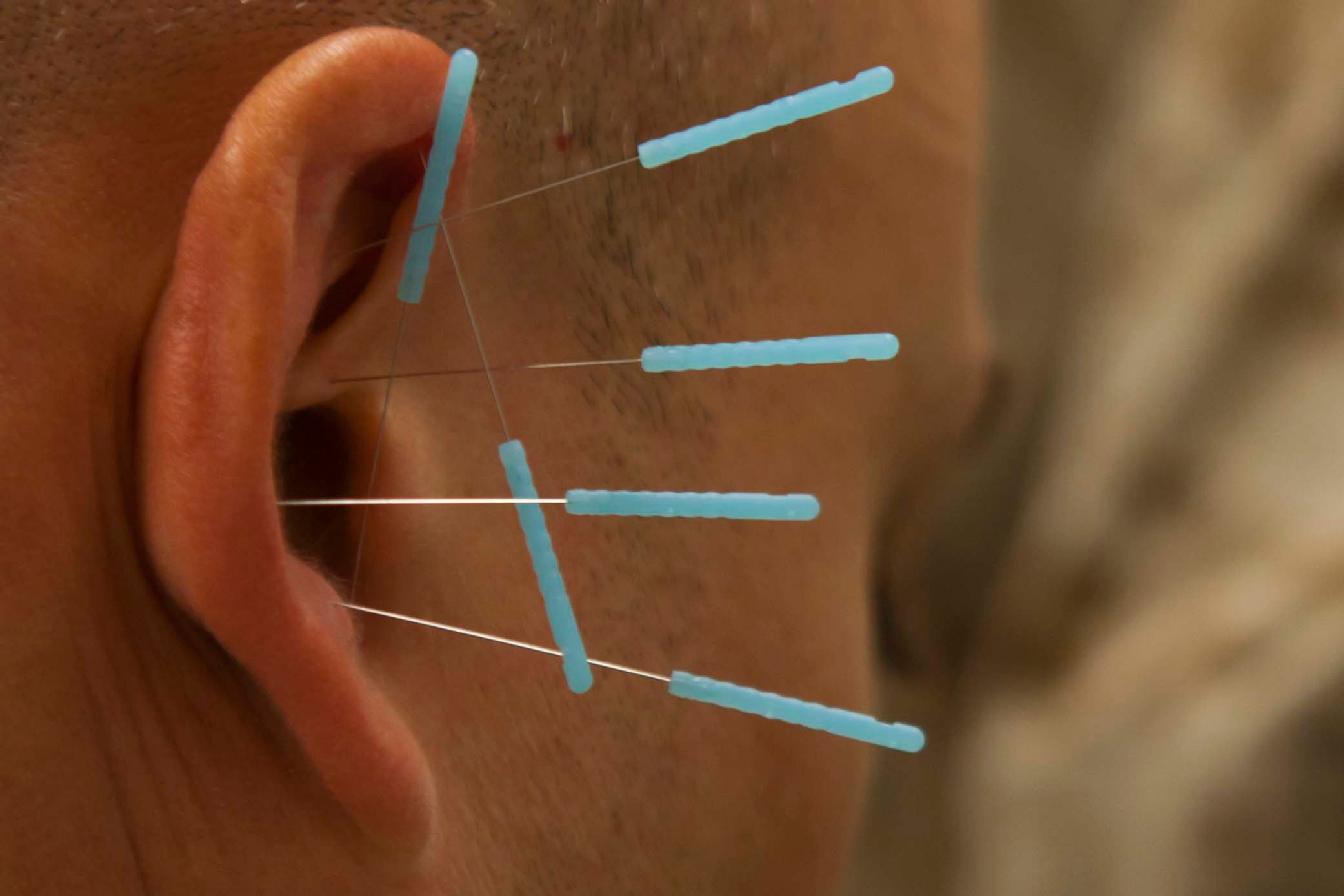 Electronic Acupuncture/ Acupressure/Scalp Needles