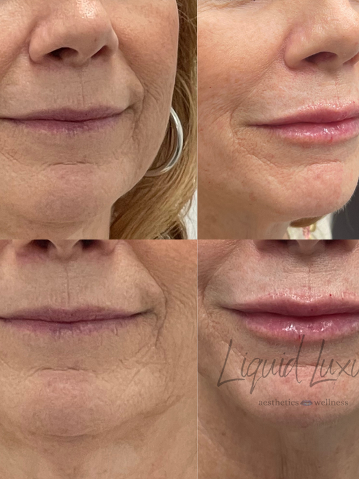 Before and After Lip Filler