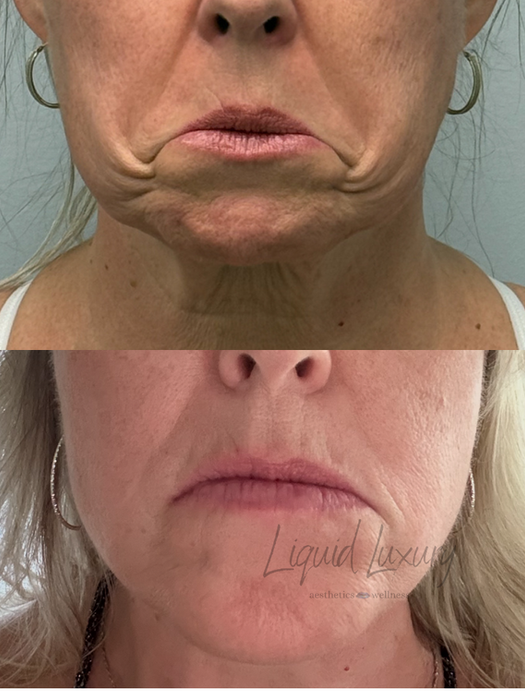 botox