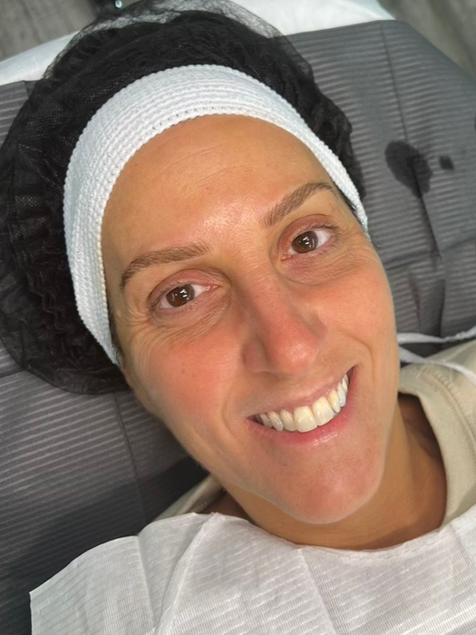 After Microblading