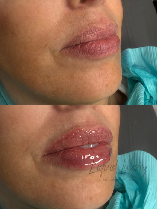 before and after lip filler