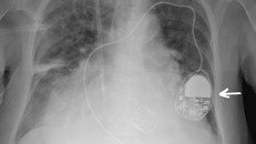 Marcapasos cardíaco