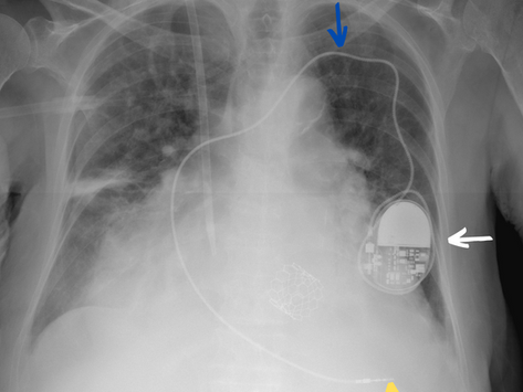Marcapasos cardíaco