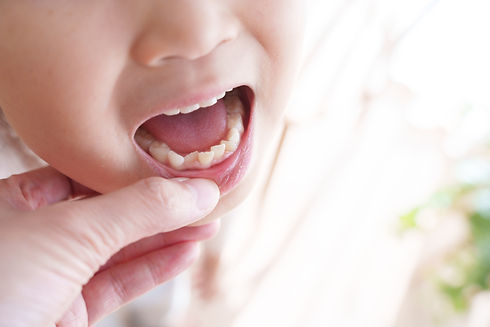 歯並びが悪い子供の口元