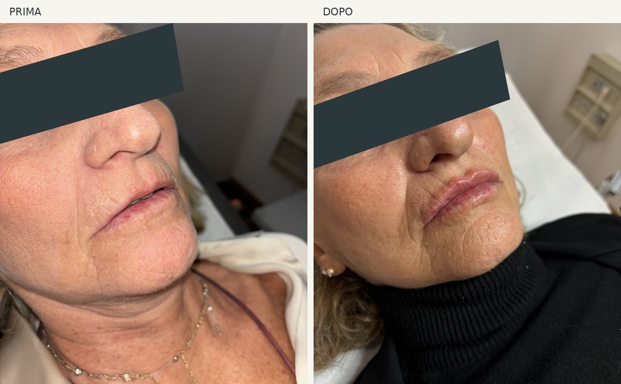 Caso 1, labbra: foto prima e dopo, occhi oscurati