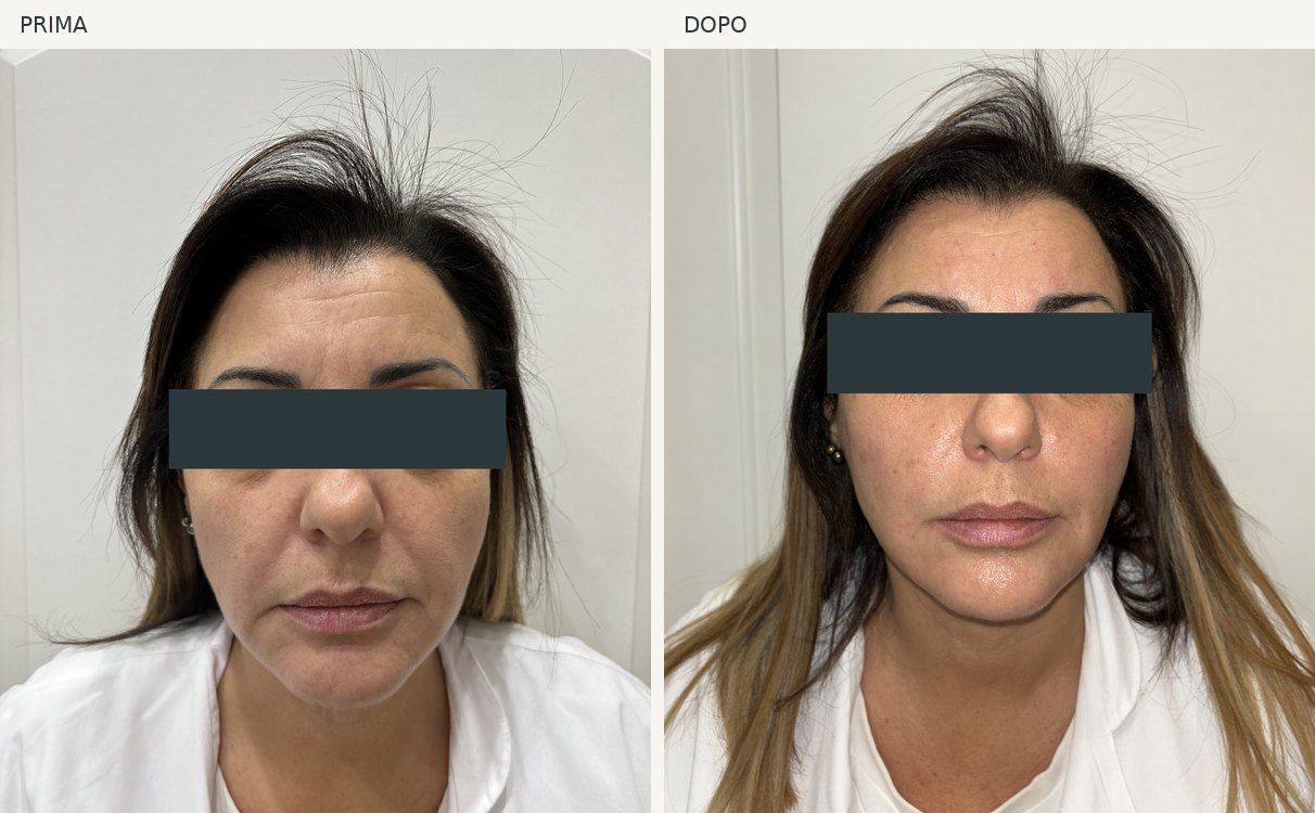 Caso 9, viso: foto prima e dopo, occhi oscurati