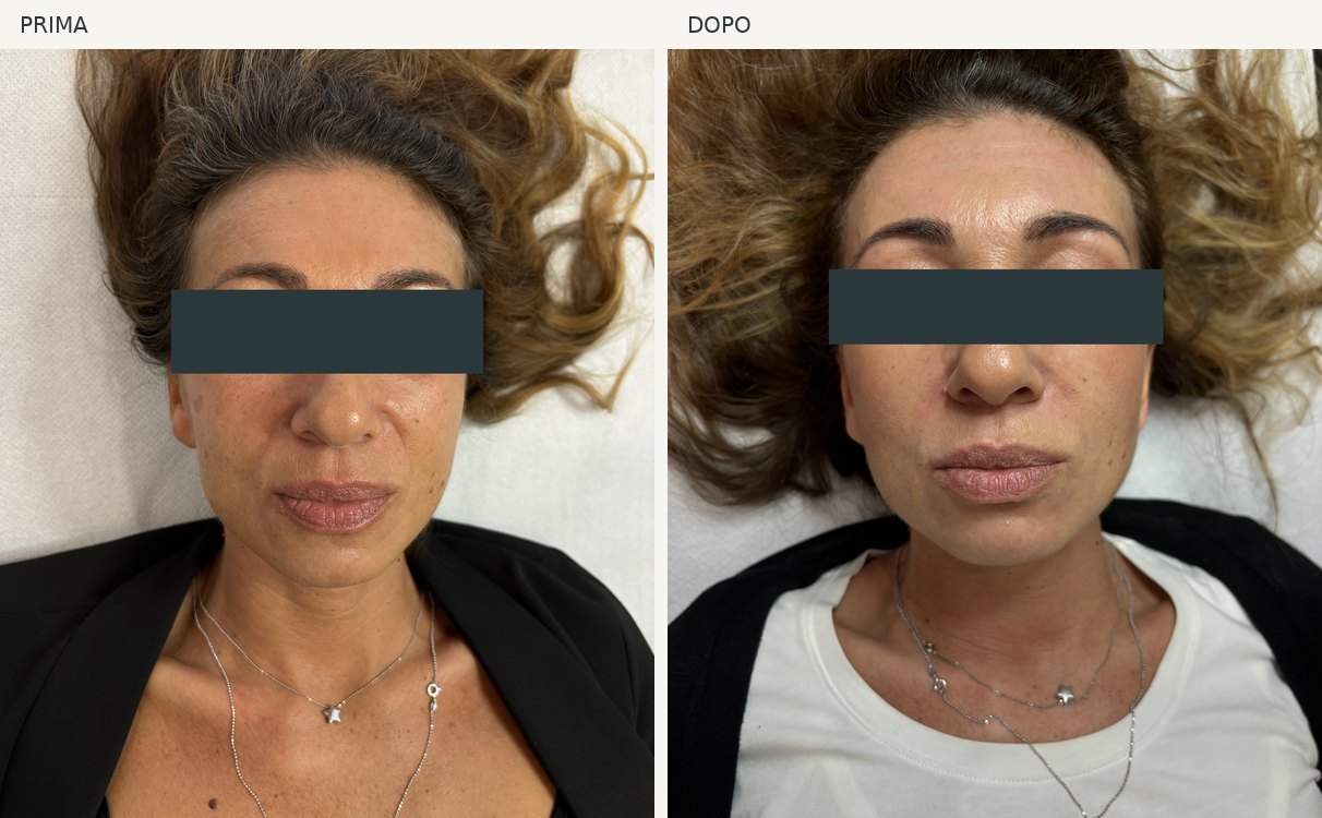 Caso 5, viso: foto prima e dopo, occhi oscurati