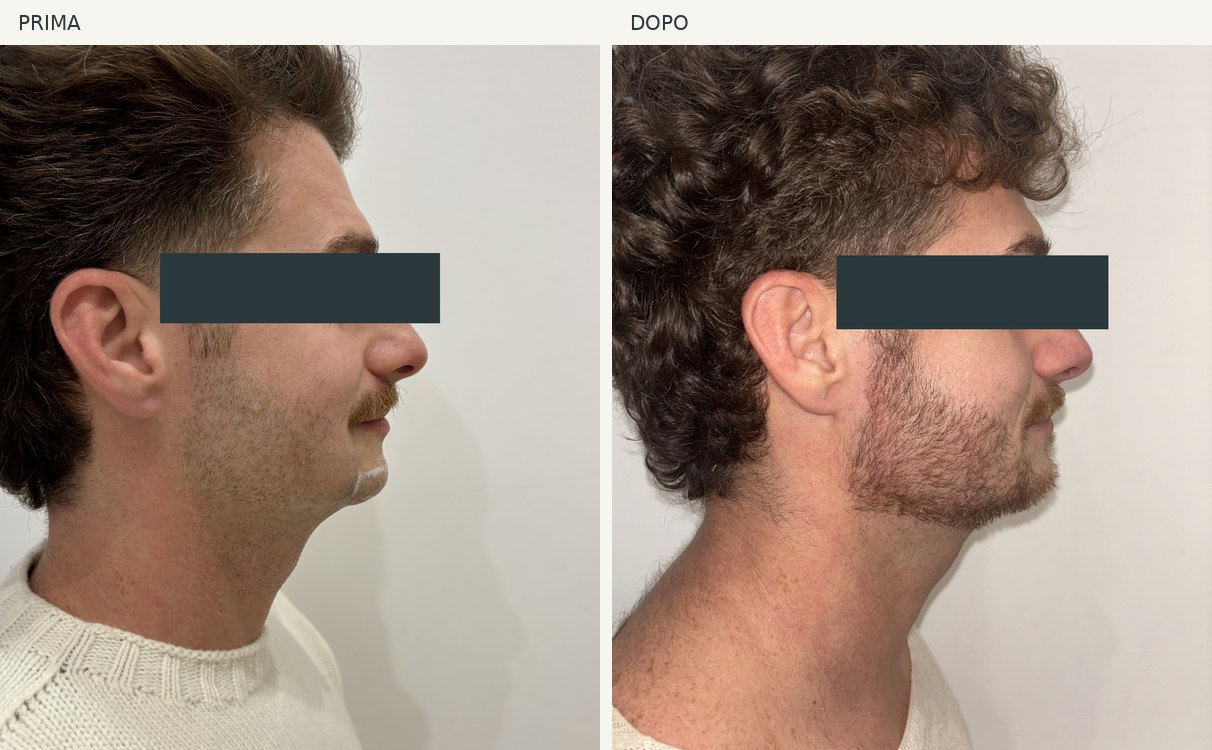 Caso 6, profilo e mento: foto prima e dopo, occhi oscurati