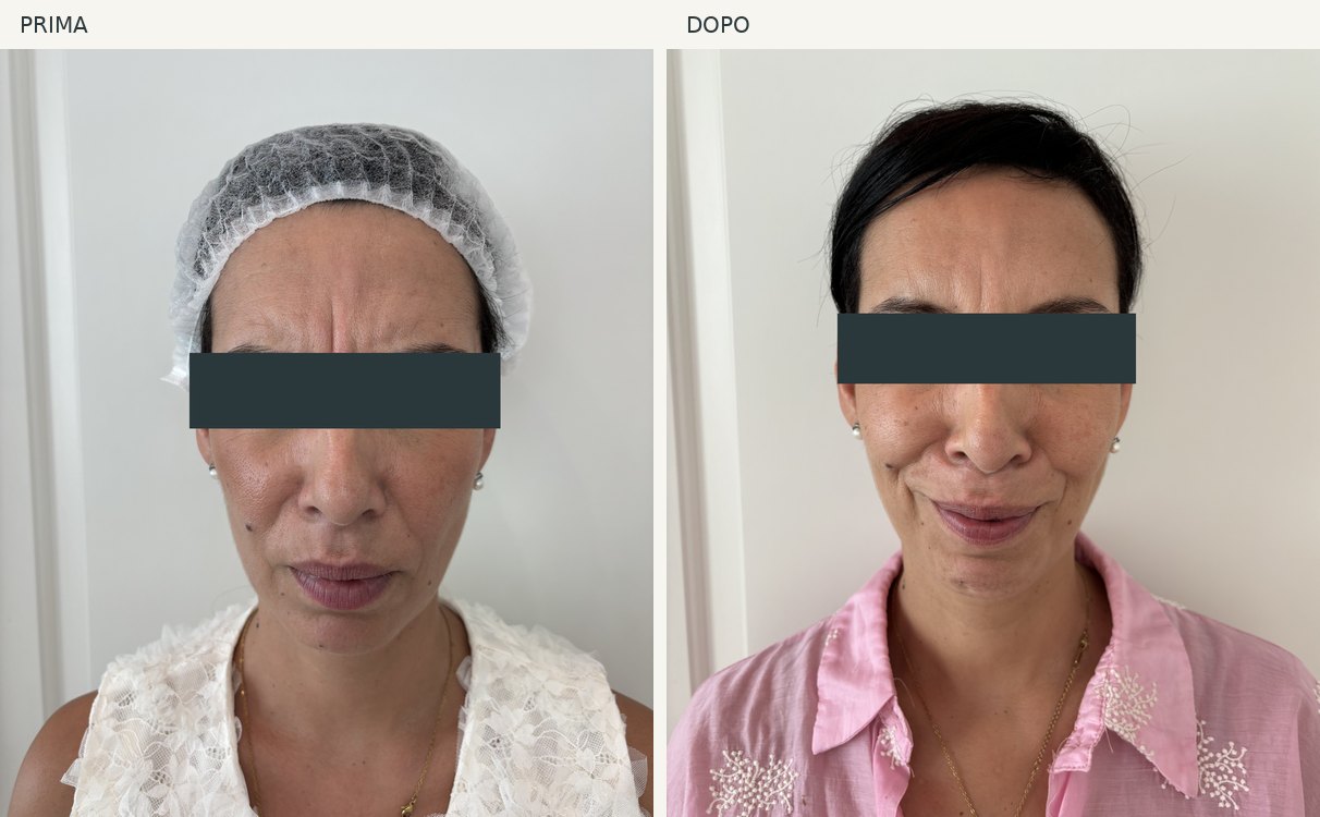 Caso 7, fronte e glabella: foto prima e dopo, occhi oscurati