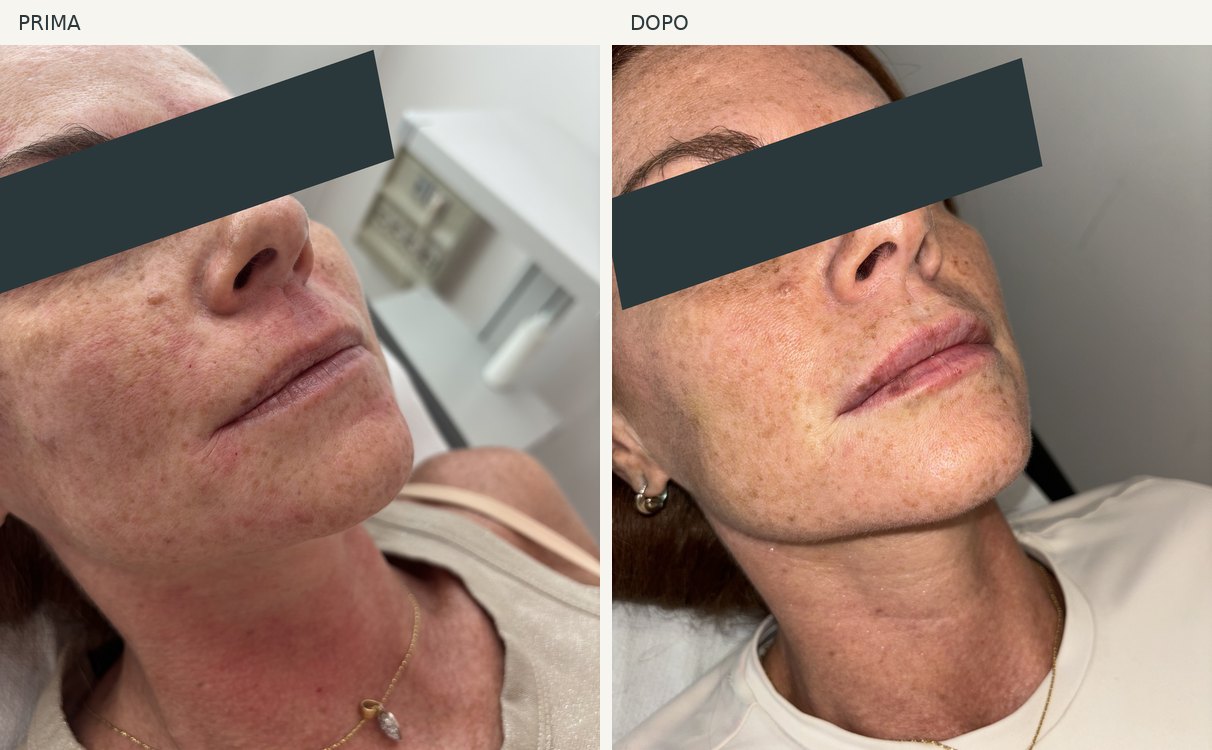 Caso 3, viso: foto prima e dopo, occhi oscurati