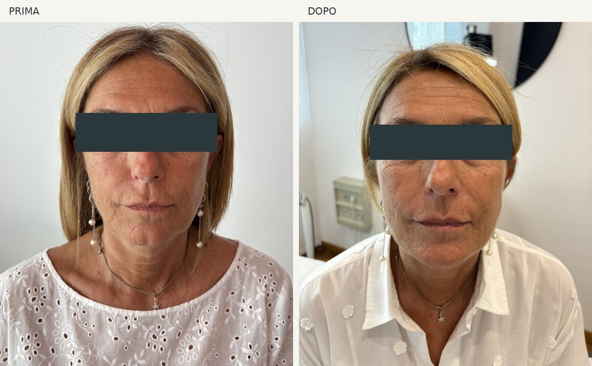 Caso 8, viso: foto prima e dopo, occhi oscurati