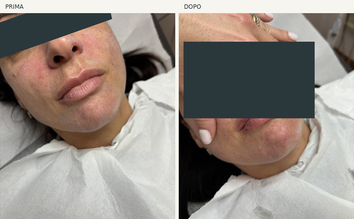 Caso 10, labbra: foto prima e dopo, occhi oscurati