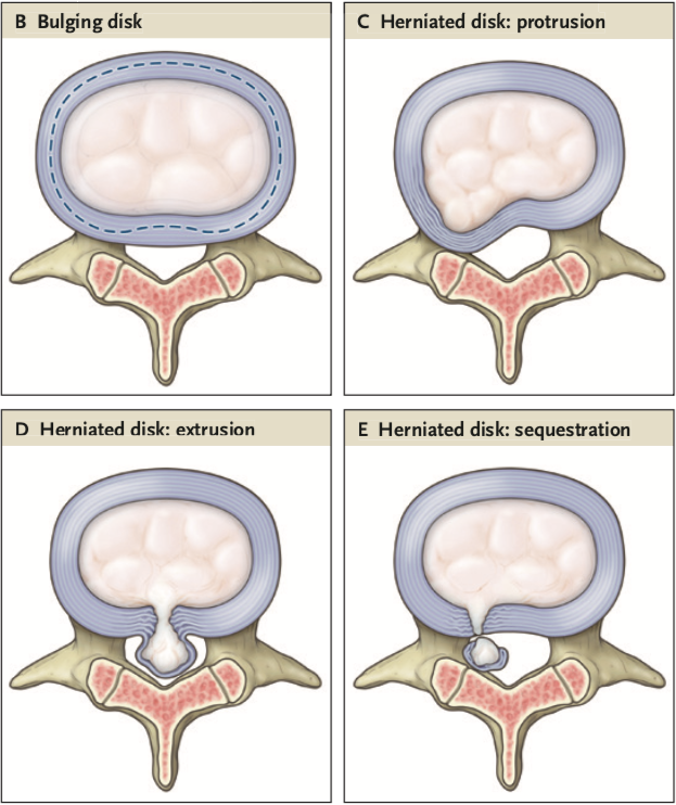 Hernia discal lumbar. Las 10 cosas que debes saber antes de operarte.