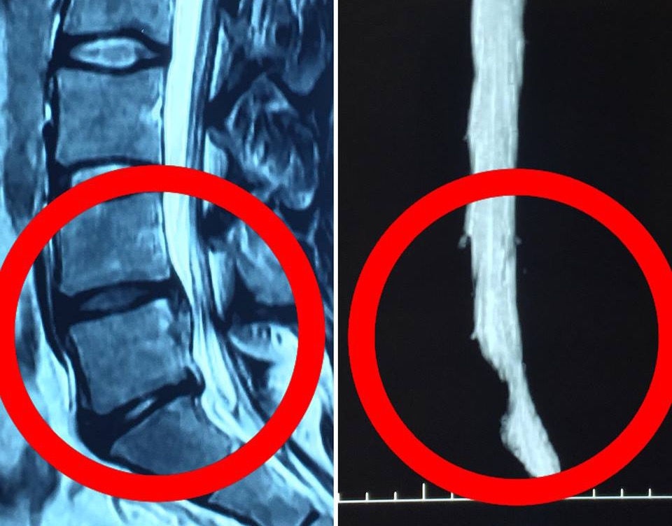 Lumbar Hernia Ultrasound vrogue.co