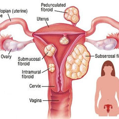 Fibroid Nutrition: Foods to Manage and Prevent Fibroid.