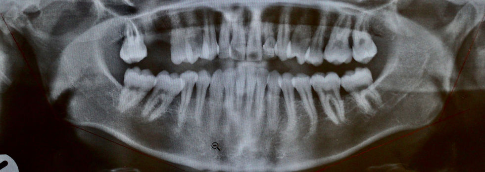 Pre-ortho OPG  21.06.2015.jpeg