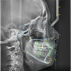 cephalometric-analysis.png