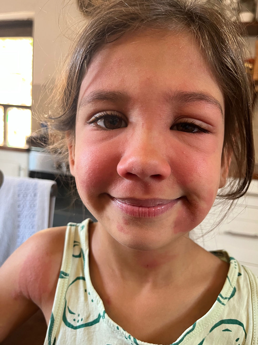 We have discovered that Emma is allergic to Mango trees