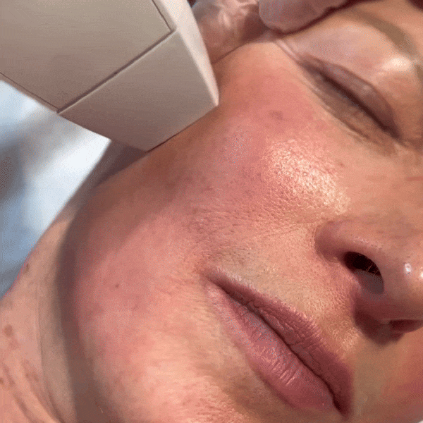 Woman having NanoFractional Treatment