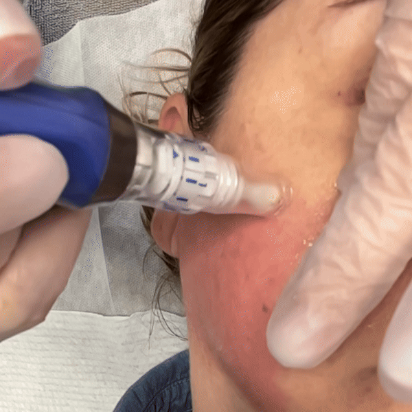 Skinpen microneedling in action