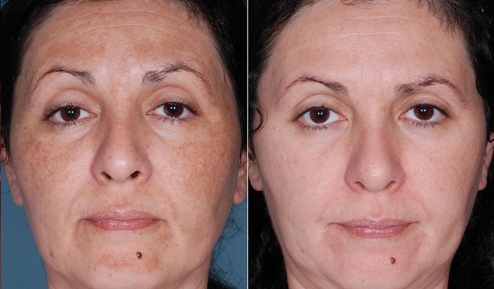 chemical-peel-3