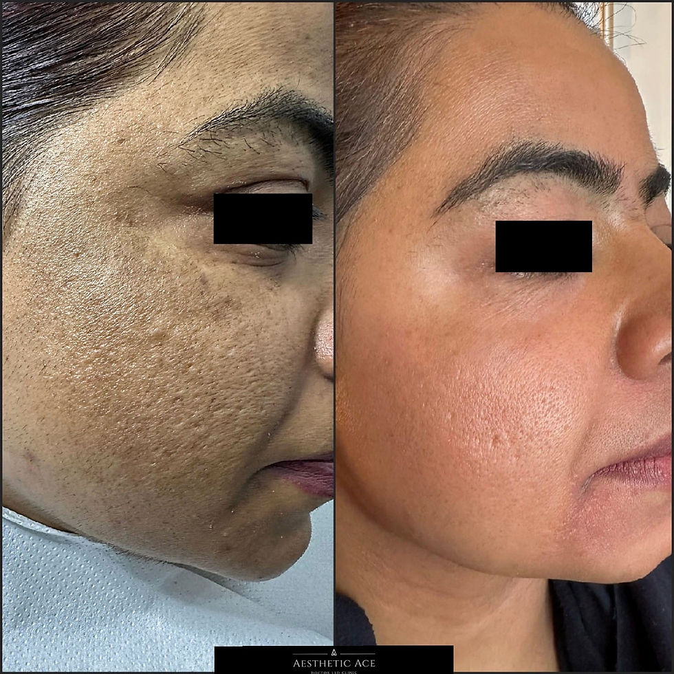 Cosmelan peel
