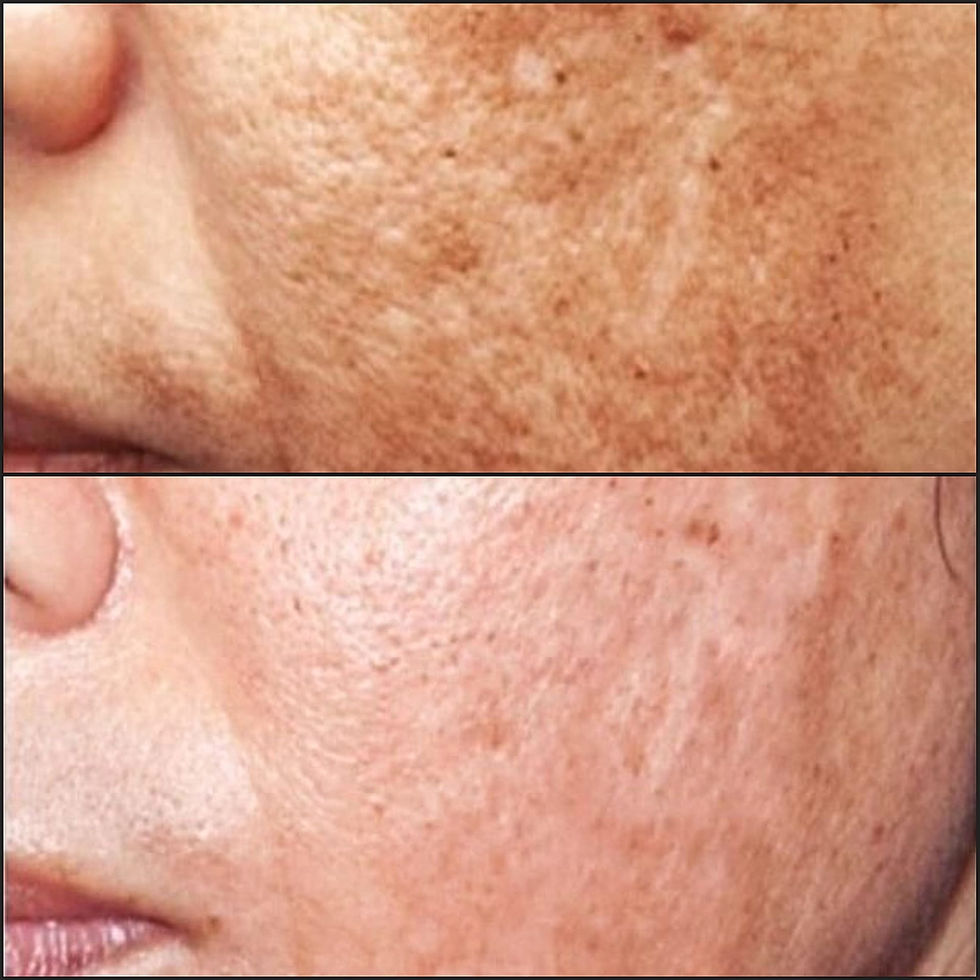 Cosmelan peel
