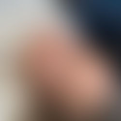 Dermapen4