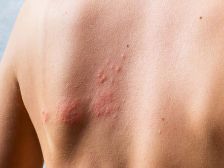 Lugares de tu cuerpo donde aparece el Herpes Zóster