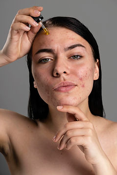 retrato-de-mujer-joven-confiado-con-acne.jpg
