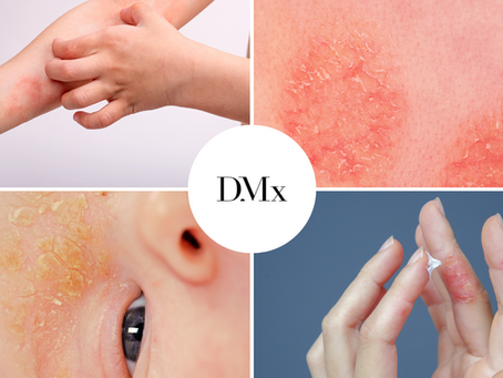 Más Allá de la Piel: Entendiendo la Dermatitis Atópica 🌟