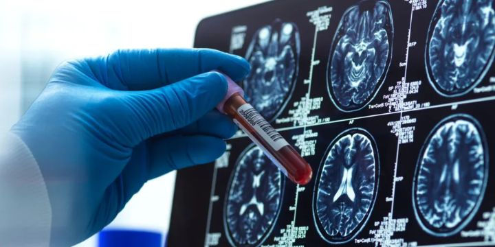 Alzheimer's blood test could 'revolutionise' diagnosis