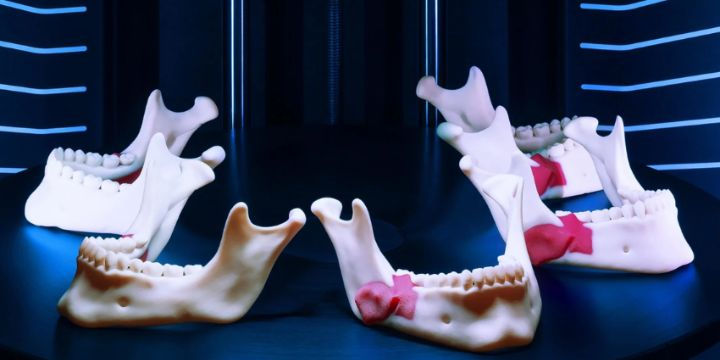 A close-up shot shows multiple 3D-printed jaw models, some with red sections indicating bone grafts, displayed on a dark surface with a subtle blue light, possibly within a 3D printer enclosure.