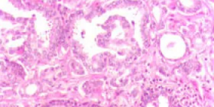 New study unveils key strategies against drug-resistant prostate cancer