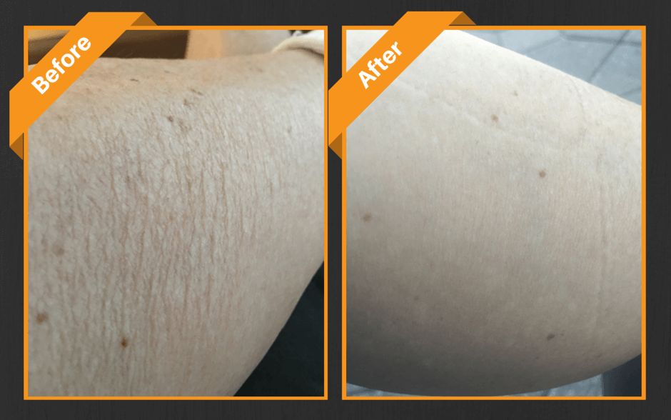 How To Get Rid Of Crepey Skin