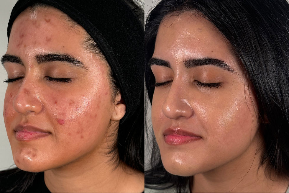 Acne Laser Treatment in Corona, CA: Clear Skin Without Downtime