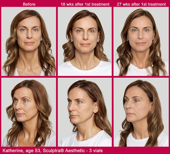 Sculptra Before and After Derma Aesthetica Med Spa .jpeg