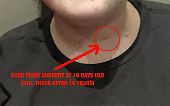 Scar from Surgery - Lymphatic Malformation Cyst