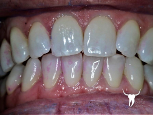 Preventative Care and Pink Teeth