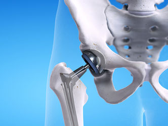 Fisioterapia dopo una protesi d’anca o di ginocchio