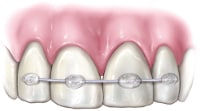 Knocked-Out-Tooth-Repaired.jpeg