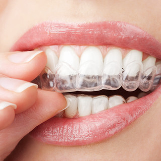 Invisalign Treatment Treatment Tel Aviv