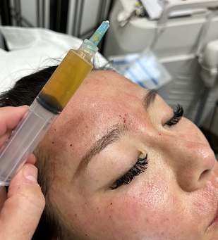 Microneedling with PRP: The Ultimate Skin Rejuvenation Treatment
