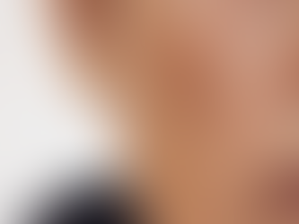 The Complete Guide to Understanding Melasma: Causes, Effects, and Effective Treatments for Clearer Skin