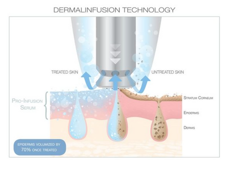 Clear, Smooth, Confident: The Back Dermalinfusion Facial