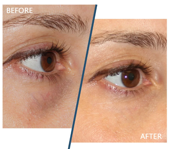 Brighten, Smooth & Rejuvenate: Salmon DNA Under Eye Injections