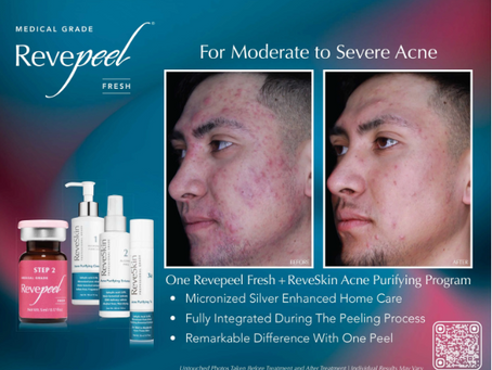 ReveSkin Fresh Peel vs. ReveSkin Advanced Peel: Which Chemical Peel Is Right for You?