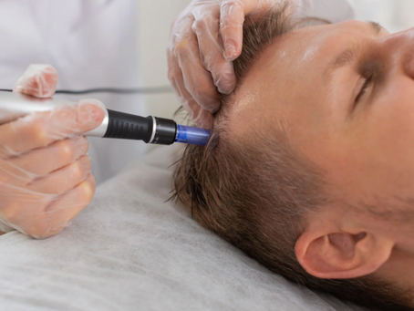 Microneedling the Scalp with Hair Exosomes: Advanced Hair Restoration at Renovo